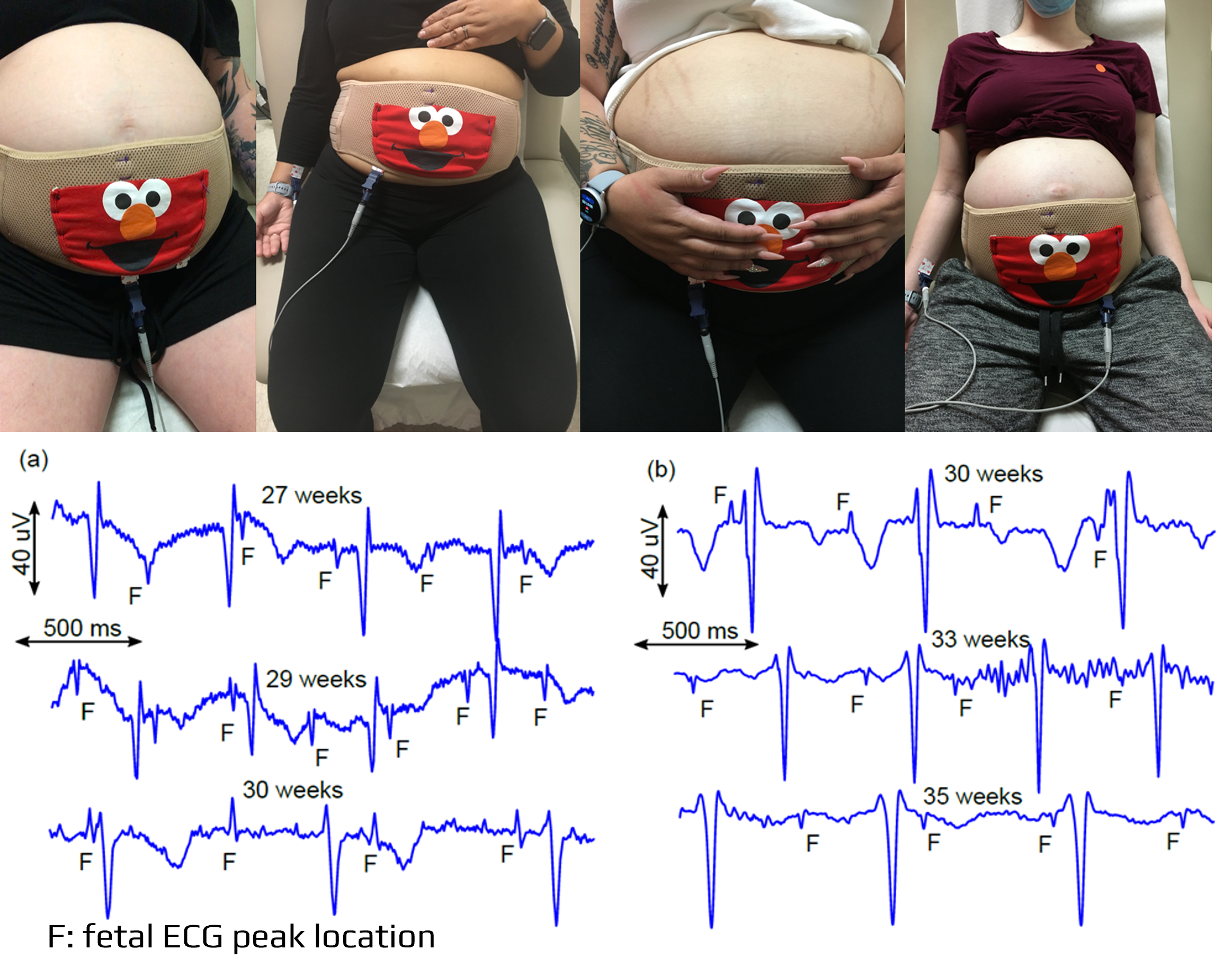 Fetal/maternal ECG home monitoring device
